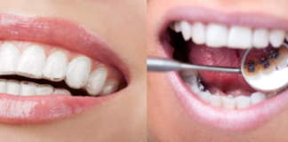 ortodoncia invisalign en madrid